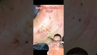 BLACKHEAD REMOVAL SURPRISE - We Didnt Expect This!! #shorts