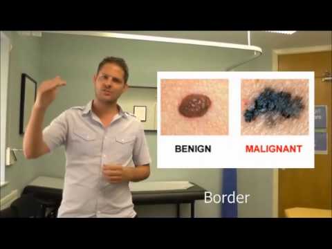 How to recognise if a mole is normal or suspicious