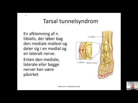 Mortons neurom og tarsal tunnelsyndrom