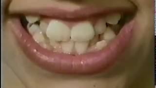 Kesling and Rocke Orthodontic Group    timelapse film of treatment with the Tip Edge Bracket