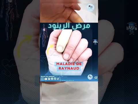 مرض رينود او متلازمة رينود    حالة مرضية نادرة و ظاهرة غريبة