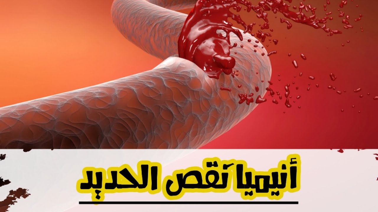 أنيميا نقص الحديد / أعراض وأسباب وعلاج ..