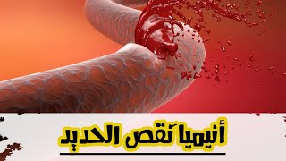 أنيميا نقص الحديد / أعراض وأسباب وعلاج ..