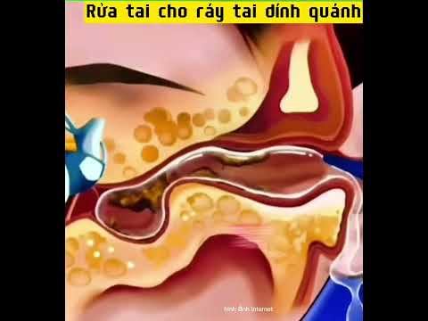 Video Rửa Tai_Ráy Tai Quánh bánh đúc - youtube