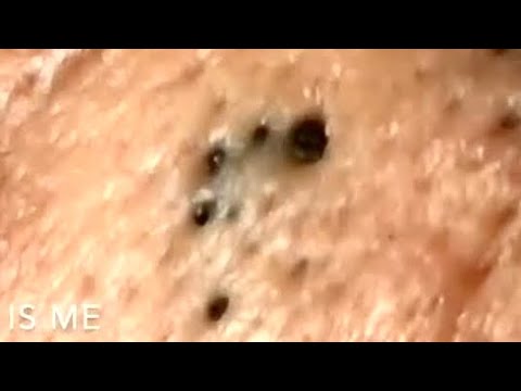 Blackheads. Now the skin is smooth?