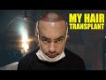 MY HAIR LOSS JOURNEY | GETTING A HAIR TRANSPLANT IN TURKEY | DHI TRANSPLANT