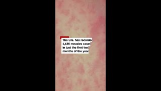 US records more than 1,100 measles cases in 2026