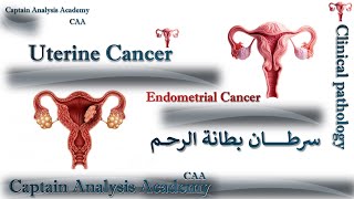Uterine Cancer (Endometrial Cancer ) سرطان بطانة الرحم وما هى اسباب +  اعراضه  تشخيصه + علاج #Cancer