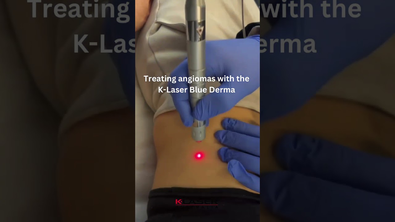Angioma removal with K-Laser. One treatment required. 