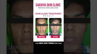 Results of Skinglow Treatment #skinglow #skincare #glowingskin #glowing