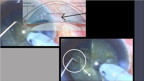 Transition to direct chop Part 2- How to use the second instrument optimally during the direct chop.