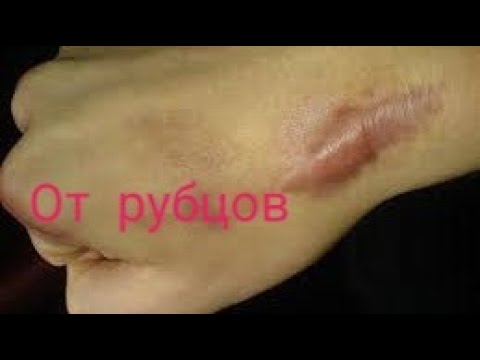 От рубцов. Аптечное средство от рубцов.