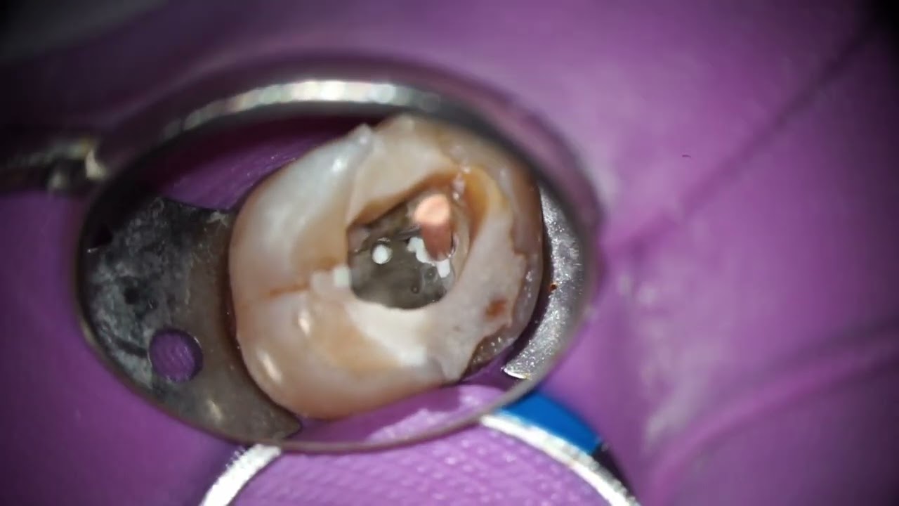 Maxillary Molar Endo Access Ultrasonic MB2 Troughing, 57 OFF