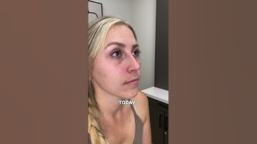 Tear Trough Filler | The Solution To Dark Circles and Under Eye Hollows