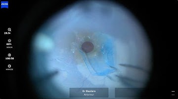 Inverted ILM flap : Tips & Tricks