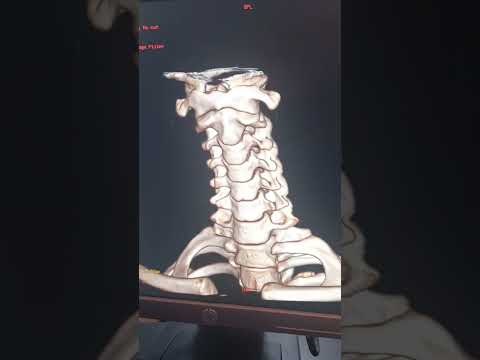 شاهد تفاصيل عظام العنق بتقنية ال 3