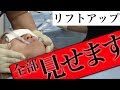 【 リフトアップ 】人気 の 整形手術 の "裏側" 全て見せます。