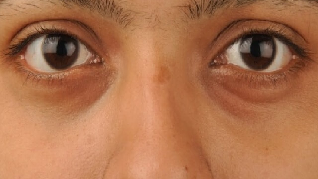 how to get rid of sleepy eyes in the morning YouTube