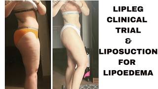 Lipoedema Liposuction Breakthrough: New Clinical Trial Results #lipoedema