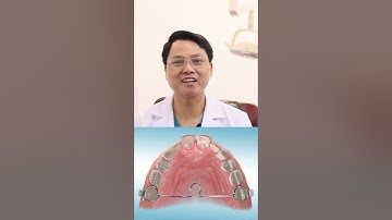 Dây cung ngang khẩu cái trong quá trình niềng răng #drcuong #nhakhoa #niengrang