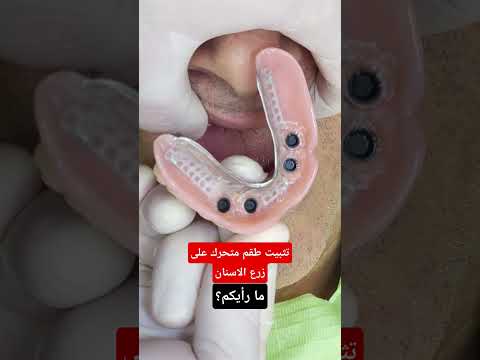 تثبيت طقم متحرك على زرع الاسنان