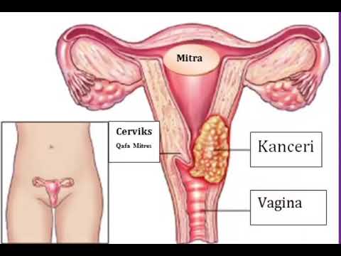 Ilustrim - Kanceri i qafës së mitrës - YouTube