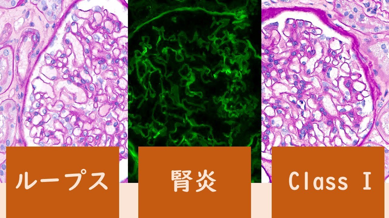 ループス腎炎 Class I - YouTube 