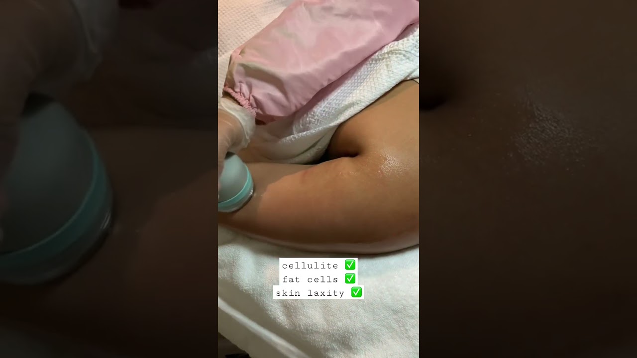 Targets fat cells and effective in treating cellulite + skin laxity: The OndaCoolwaves Plus.