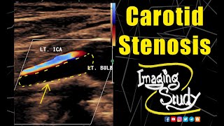 Carotid Artery Stenosis || Ultrasound || Doppler || Case 133 screenshot 5