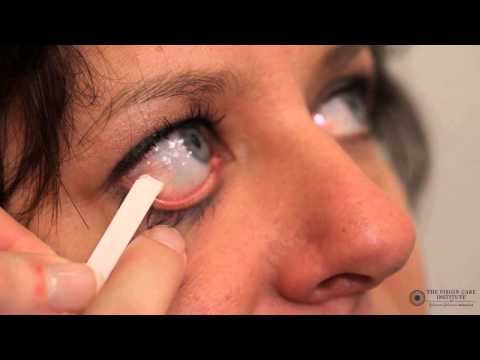 14 Slit Lamp Techniques Schirmer's test HD