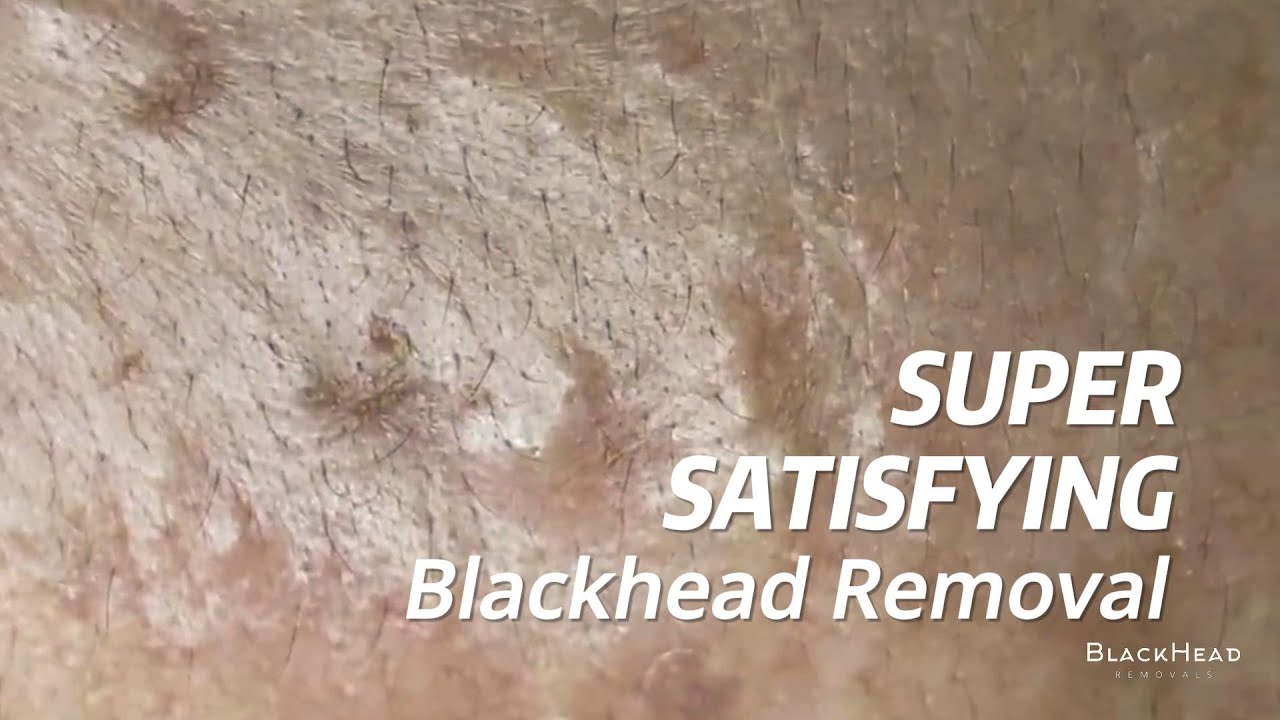 Super Satisfying BLACKHEAD REMOVAL YouTube