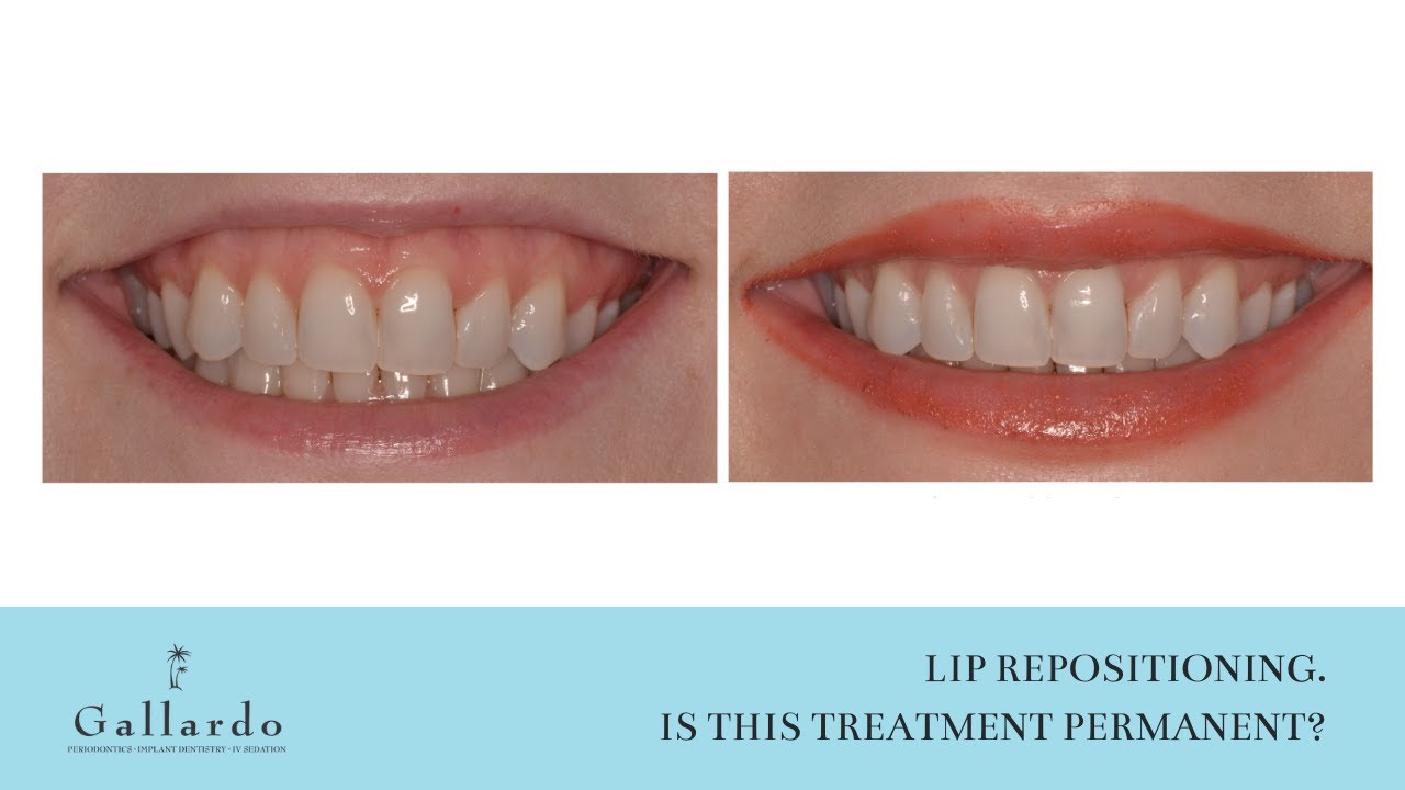 Lip Repositioning - Is this treatment permanent? - YouTube