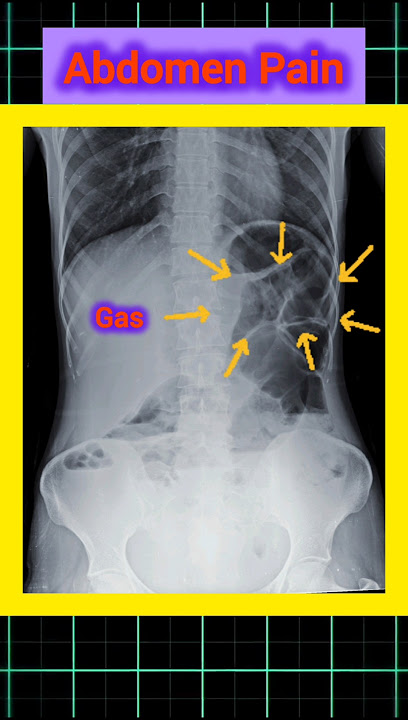 Abdomen Gas cause abdomen pain #medicalimaging