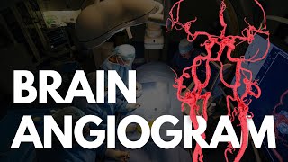 Angiogram - BRAIN angio procedure video