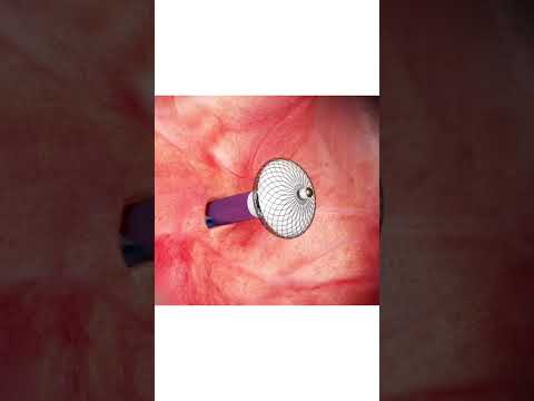 ह र ट म छ द क इल ज How To Fix A Hole In The Heart Animated Explanation 