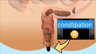 constipation explained : causes , symptom ,and treatments