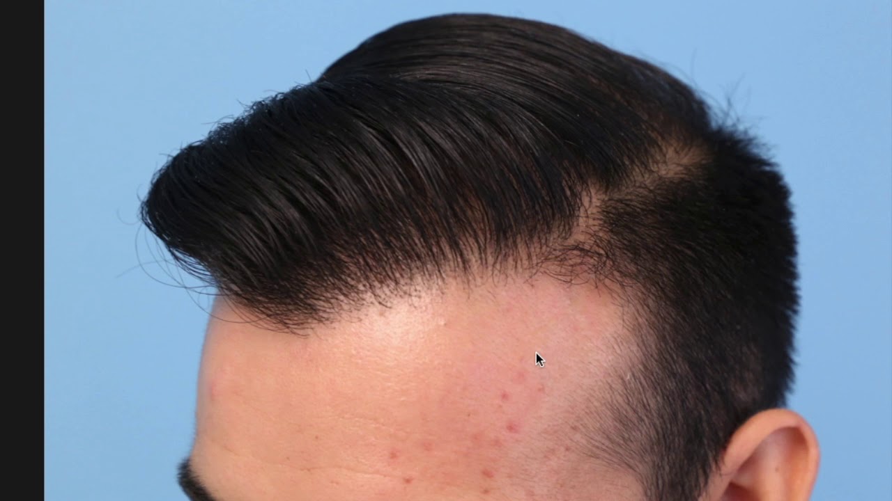 My Hair Loss Journey YouTube