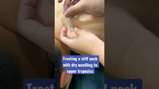 dry needling for upper trapezius #physiotherapy #dryneedling #trapezius #shorts #physio