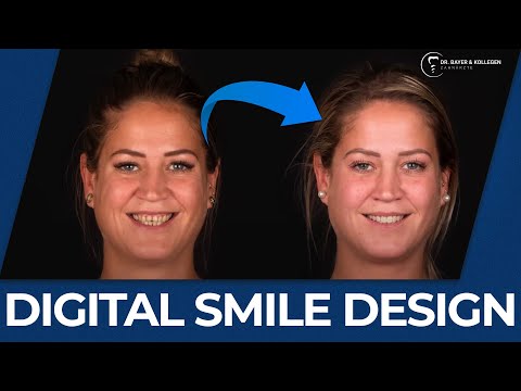 Neues Lächeln am PC // Digital Smile Design - Voll digitaler Workflow in unserer Zahnarztpraxis