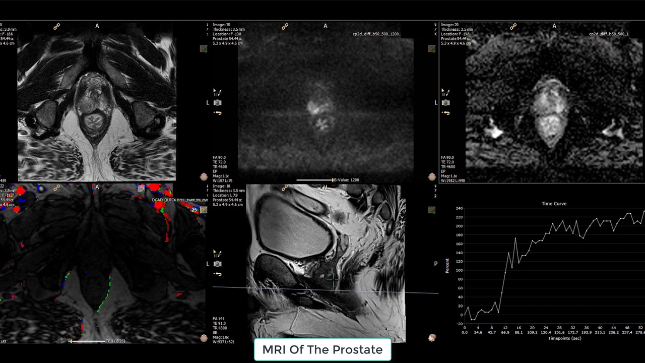 MRI Of The Prostate/ MULTIPARAMETRIC MRI OF THE PROSTATE - YouTube