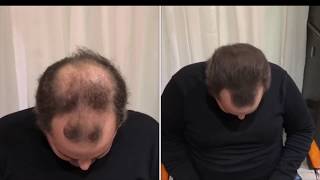 Caboki Hair Fiber Vs Hair3 - Amazing Thinning Hair In The Front And Back 