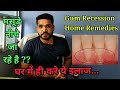 नीचे जा रहे मसूड़ो का घरेलु इलाज । Gum recession home remedies |