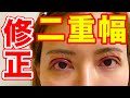 【ダウンタイム公開】二重全切開修正&眼瞼下垂の手術をしてきました