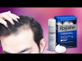 Does Minoxidil Work? - 7 Facts You Need to Know Before Using Minoxidil