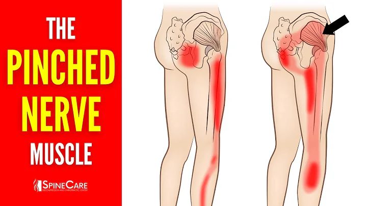 The Pinched Nerve Muscle (How to Release It for INSTANT RELIEF)