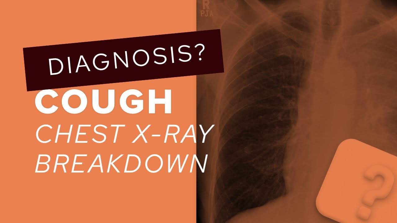 Chest XRay breakdown male smoker with a cough YouTube