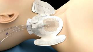 3M™ PICC/CVC Securement Dressing Application Video