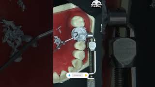 Amalgam Build-Up -Up