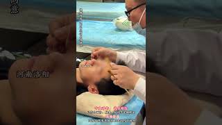 Acupuncture in traditional Chinese medicine helps regulate acne#Acupuncture in Traditional