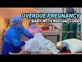 DELIVERY WITH NUCHAL CORD I OVERDUE PREGNANCY: 40 WEEKS AND 3 DAYS G3P3 I PULUPOT NA PUSOD